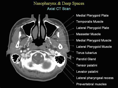 Nasopharynx And Deep Spaces In The Axial Ct Scan Medizzy