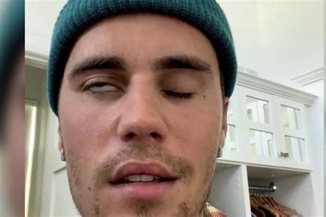 Watch Justin Bieber Says Suffering From Facial Paralysis