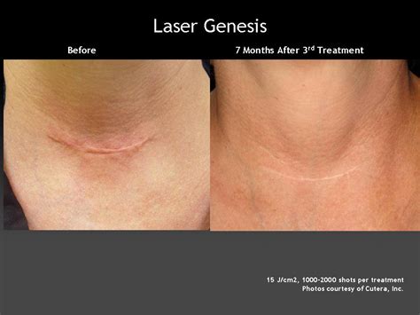 Full legs, bikini, lip, eyebrows, under arms. Cutera GenesisPlus Laser System - Spa Cielo Cabo
