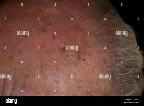 Sun Spots On Skin Cancer Images