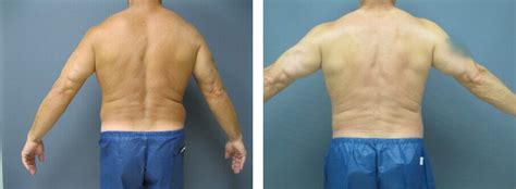 Abs And Waist Liposuction Before And After Neinstein Plastic Surgery