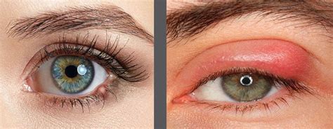Swollen Eyelids 6 Common Causes And Treatment Tips Vision Opticians