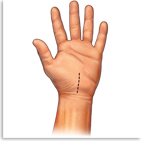 Carpal Tunnel Syndrome Treatment — My Carpal Tunnel