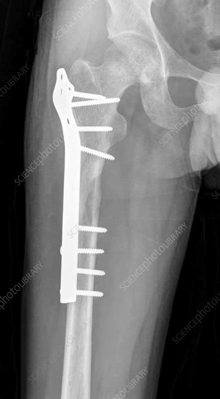 Pinned Femur Fracture X Ray Stock Image F0356040 Science Photo
