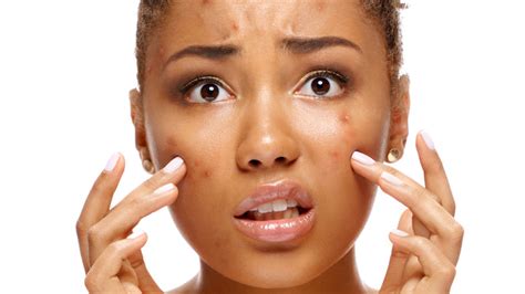 Discovernet Hormonal Acne Explained Causes Symptoms And Treatments