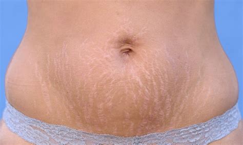 How To Maintain Stretch Marks During And After Pregnancy
