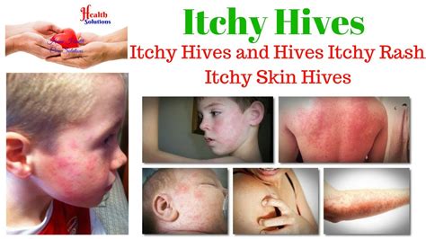 Itchy Hives Itchy Hives And Hives Itchy Rash Youtube