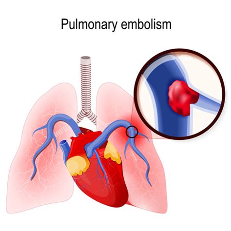 Xeljanz And Pulmonary Embolism Or Deep Vein Thrombosis