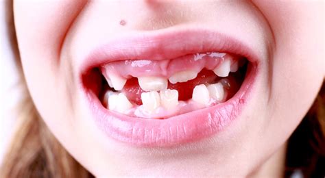 The Most Common Causes Of White Spots On Baby Teeth And How To Prevent Them