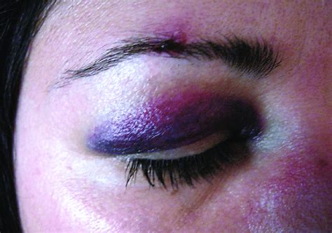 Hematoma Of The Eyelids After Blunt Trauma Download Scientific Diagram