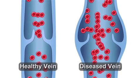 Refluxing Vein Animation Youtube