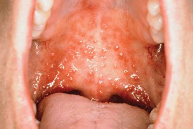 Read about oral herpes symptoms, outbreak stages, signs, treatment, transmission, and prevention. Oral herpes simplex treatment