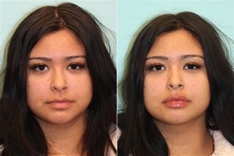 Lip Augmentation Photos Chevy Chase Md Patient 23547