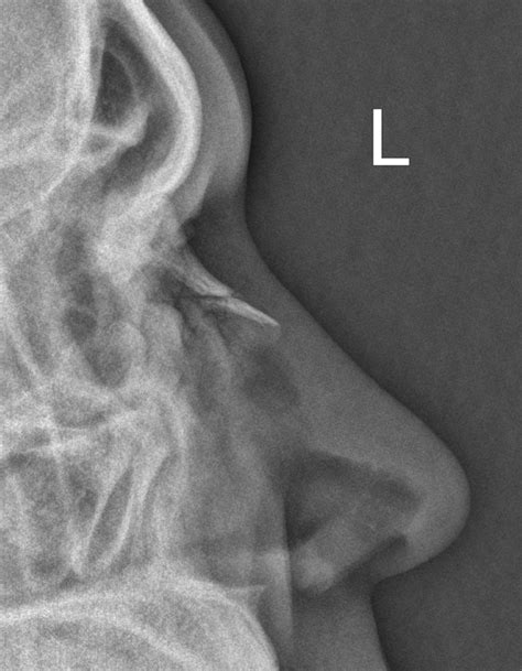 Nasal Bone Fracture Image