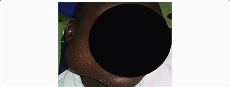 Shows 55 Cm In Diameter Firm Dome Shaped Right Parotid Swelling
