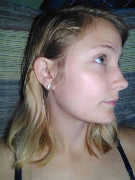 Which birth control pills work best to prevent acne? Quitting Birth Control (pics) - Hormonal acne - Acne.org