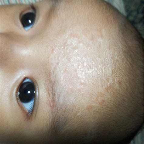 Ring Get Ringworm Like Rash On Baby Pictures
