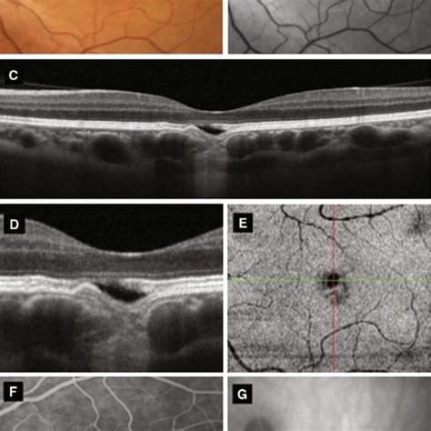 Clinical Findings Of Eyes With Focal Choroidal Excavation Download Table