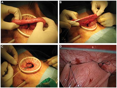 Cpt Code Gastrojejunostomy Tube Placement