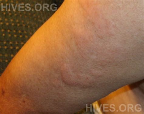 Hives Pictures Photographs Of Hives On Arms Legs Face Hands Feet