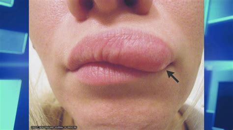 What To Do When Mosquito Bites On Lips