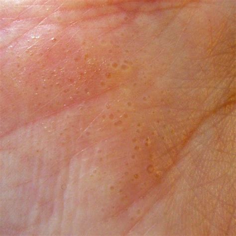 Dyshidrosis Hands And Pies What Is It Causes And Treatment