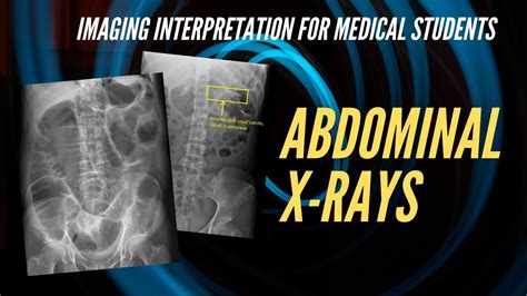 Abdominal X Ray Interpretation For Medical Students Youtube