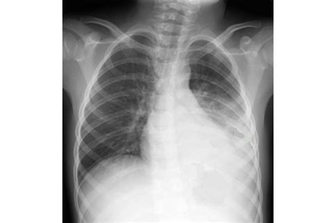 Pneumonia is by far the most common cause of consolidation. 