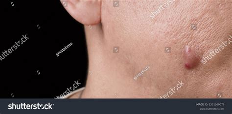 Infected Incision Images Browse 1157 Stock Photos And Vectors Free