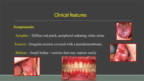 Precancerous Lesions Of Oral Cavity