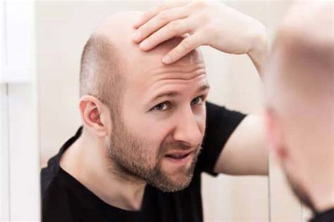 Balding Can Hair Grow Back After Balding Man Matters