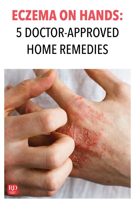 Eczema On Hands 5 Doctor Approved Home Remedies Home Remedies For