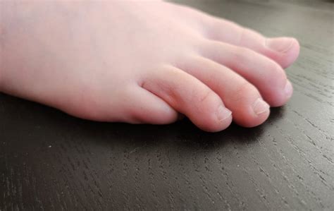 Pinky Toe Underlapping Causes Effects And Treatment Options