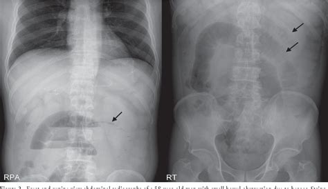 Small Bowel Ileus Semantic Scholar