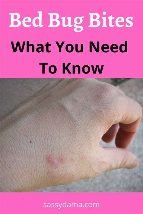 How To Treat Bed Bug Bites And Eliminate Infestation Rid Of Bed Bugs