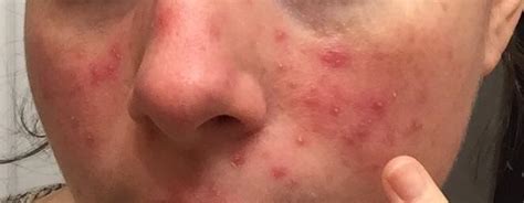 Routine Help I Get These Red Bumps All Over My Face Especially In