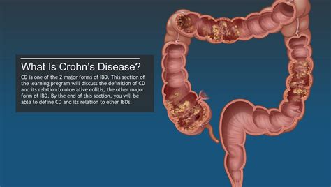Obesity isn't just a cosmetic concern. Understanding Crohn's Disease-A.D.A.M. OnDemand