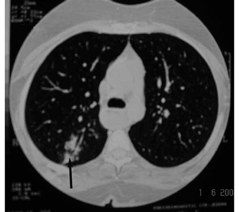 High Resolution Ct Scan Of The Chest Showing Patchy Air Space