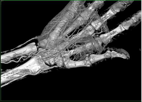Vascular Map Of The Wrist And Hand In 3d Musculoskeletal Case Studies