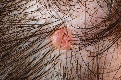 Sore Spots On Scalp Hair Loss Raised Sores On Scalp Pictures