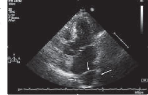 Figure 1 From An Unusual Echocardiographic Image Of A Hiatal Hernia