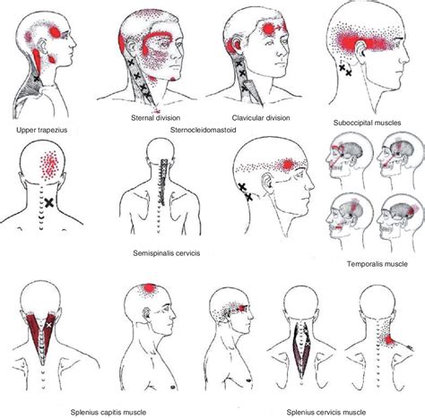Figure 1 Referred Pain Patterns From Upper Trapezius
