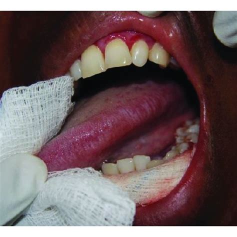 Mild Oral Hairy Leukoplakia Of The Left And Right Lateral Borders Of