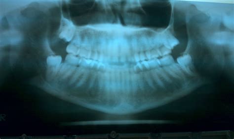 X Ray Of My Impacted Wisdom Teeth Dental Health Oral Health Impacted