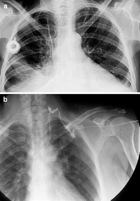 A Chest X Ray In A Left Breast Cancer Patient Before Chemotherapy