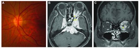 Pre Treatment Fundoscopy And Brain Magnetic Resonance Imaging Mri