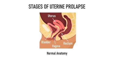 Prolapsed Uterus Stages