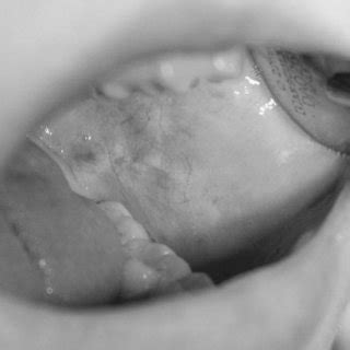 Erethematous Spots And Erosions Of The Palate Of A 14 Year Old Patient