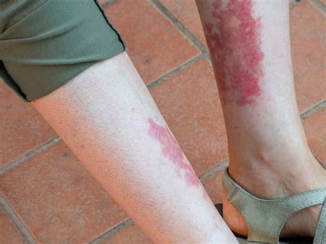 Czerwone plamy na nogach jakie są przyczyny co oznaczają jak się Hot