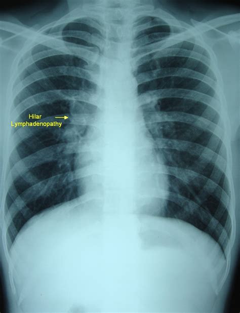 Hilar Lymphadenopathy X Ray Pg Blazer